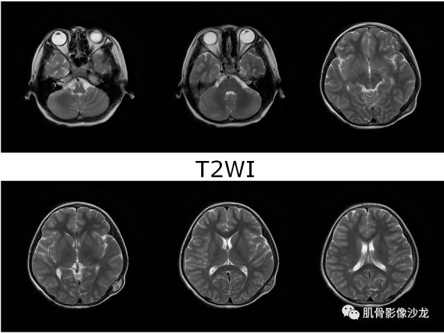 【病例】罗道病RDD一例CT及MR影像表现 【病例】罗道病RDD一例CT及MR影像表现