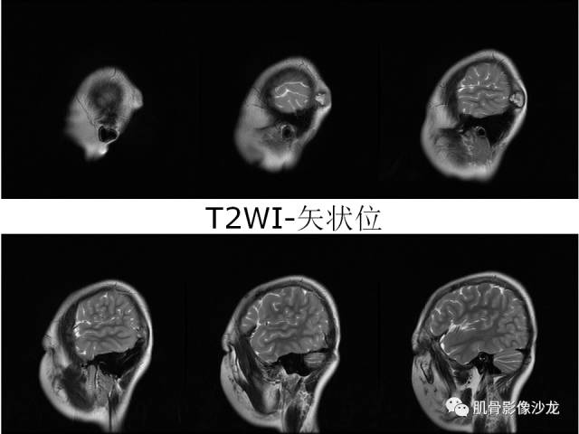 【病例】罗道病RDD一例CT及MR影像表现 【病例】罗道病RDD一例CT及MR影像表现