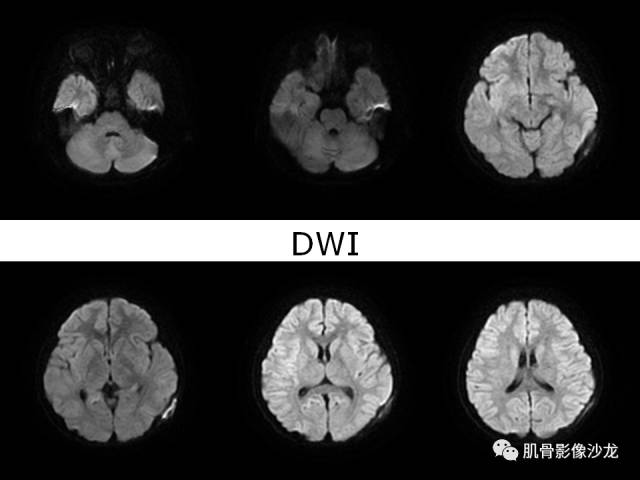 【病例】罗道病RDD一例CT及MR影像表现 【病例】罗道病RDD一例CT及MR影像表现
