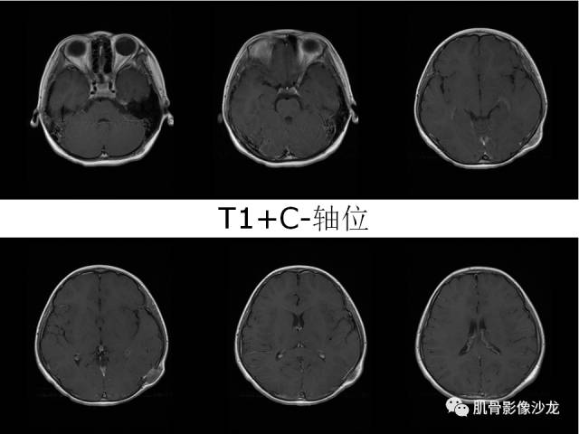 【病例】罗道病RDD一例CT及MR影像表现 【病例】罗道病RDD一例CT及MR影像表现