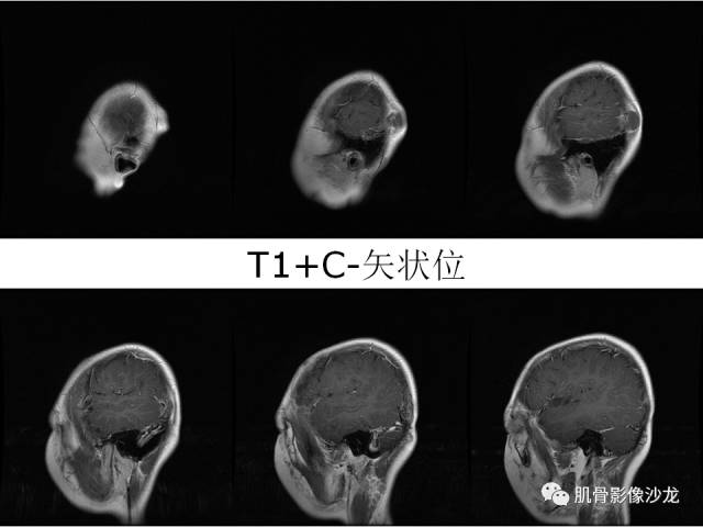 【病例】罗道病RDD一例CT及MR影像表现 【病例】罗道病RDD一例CT及MR影像表现