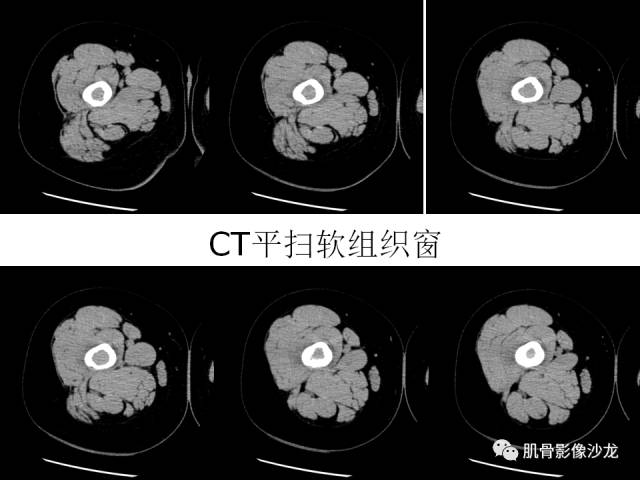 【病例】罗道病RDD一例CT及MR影像表现 【病例】罗道病RDD一例CT及MR影像表现