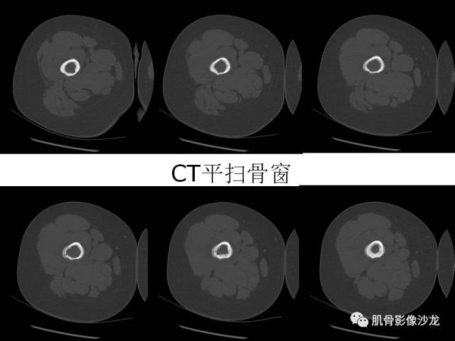 【病例】罗道病RDD一例CT及MR影像表现 【病例】罗道病RDD一例CT及MR影像表现
