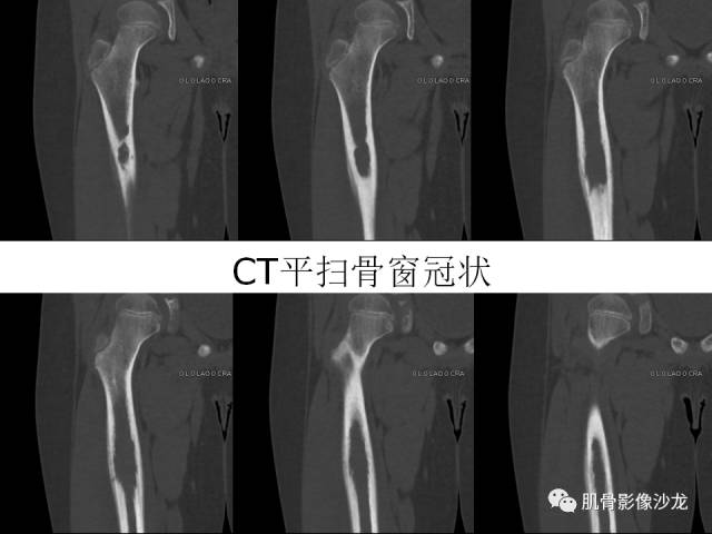 【病例】罗道病RDD一例CT及MR影像表现 【病例】罗道病RDD一例CT及MR影像表现
