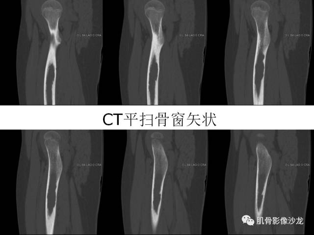 【病例】罗道病RDD一例CT及MR影像表现 【病例】罗道病RDD一例CT及MR影像表现