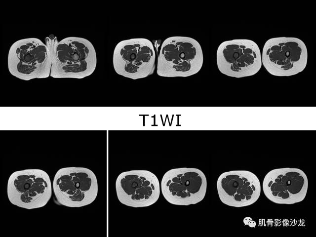 【病例】罗道病RDD一例CT及MR影像表现 【病例】罗道病RDD一例CT及MR影像表现
