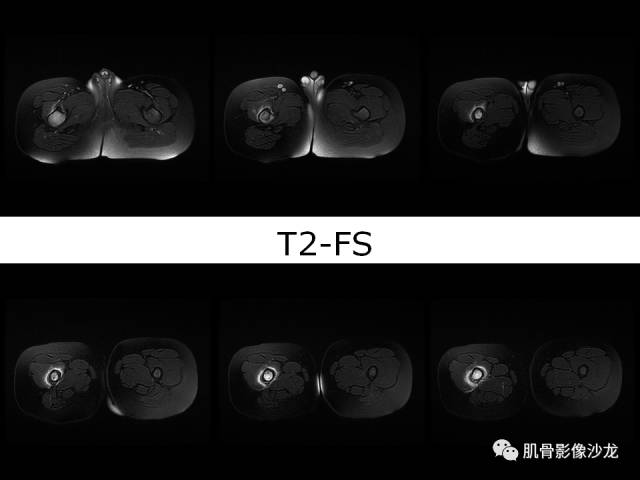 【病例】罗道病RDD一例CT及MR影像表现 【病例】罗道病RDD一例CT及MR影像表现