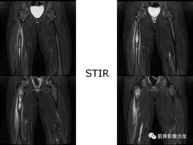 【病例】罗道病RDD一例CT及MR影像表现 【病例】罗道病RDD一例CT及MR影像表现