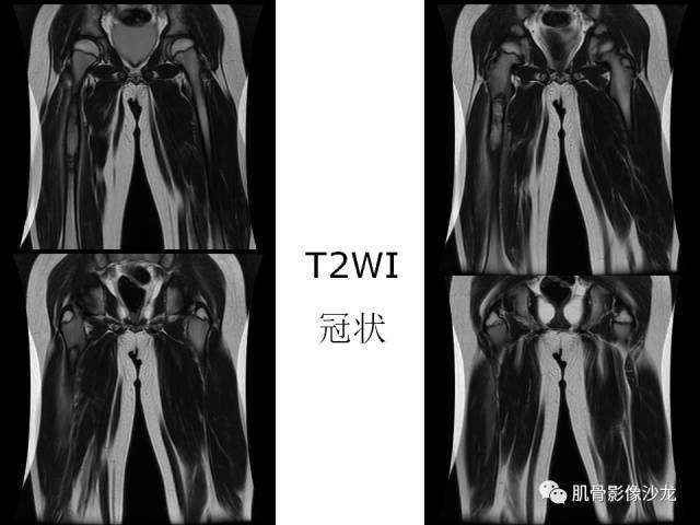 【病例】罗道病RDD一例CT及MR影像表现 【病例】罗道病RDD一例CT及MR影像表现