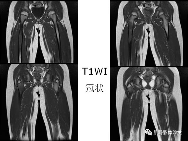 【病例】罗道病RDD一例CT及MR影像表现 【病例】罗道病RDD一例CT及MR影像表现