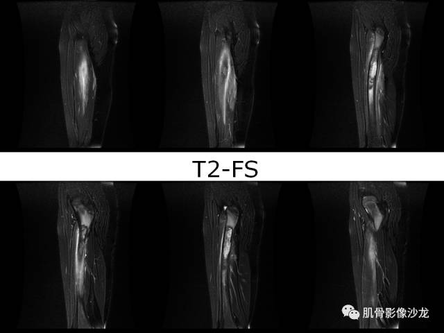 【病例】罗道病RDD一例CT及MR影像表现 【病例】罗道病RDD一例CT及MR影像表现