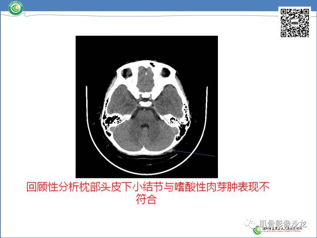 【病例】罗道病RDD一例CT及MR影像表现 【病例】罗道病RDD一例CT及MR影像表现