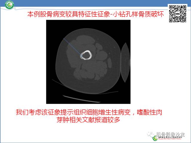 【病例】罗道病RDD一例CT及MR影像表现 【病例】罗道病RDD一例CT及MR影像表现