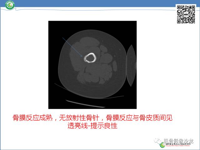 【病例】罗道病RDD一例CT及MR影像表现 【病例】罗道病RDD一例CT及MR影像表现