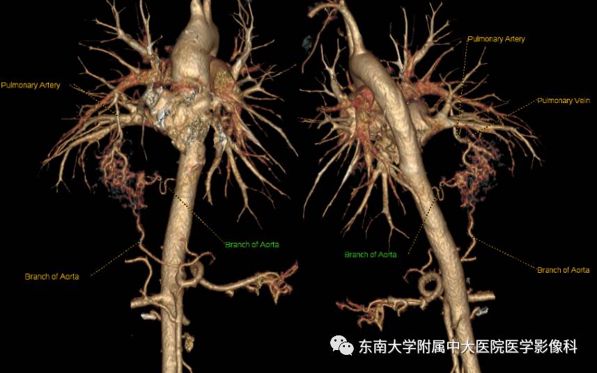 【病例】肺隔离症1例CT影像表现
