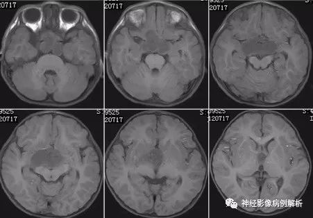 【病例】毛细胞型星形细胞瘤1例MR影像表现 【病例】毛细胞型星形细胞瘤1例MR影像表现