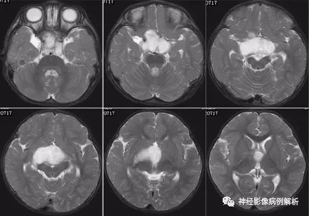 【病例】毛细胞型星形细胞瘤1例MR影像表现