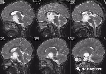 【病例】毛细胞型星形细胞瘤1例MR影像表现 【病例】毛细胞型星形细胞瘤1例MR影像表现