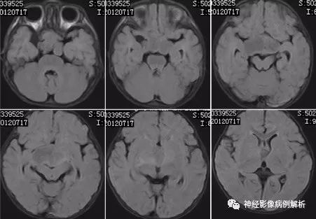 【病例】毛细胞型星形细胞瘤1例MR影像表现 【病例】毛细胞型星形细胞瘤1例MR影像表现
