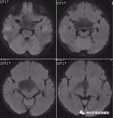【病例】毛细胞型星形细胞瘤1例MR影像表现 【病例】毛细胞型星形细胞瘤1例MR影像表现