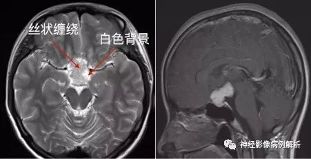 【病例】毛细胞型星形细胞瘤1例MR影像表现 【病例】毛细胞型星形细胞瘤1例MR影像表现