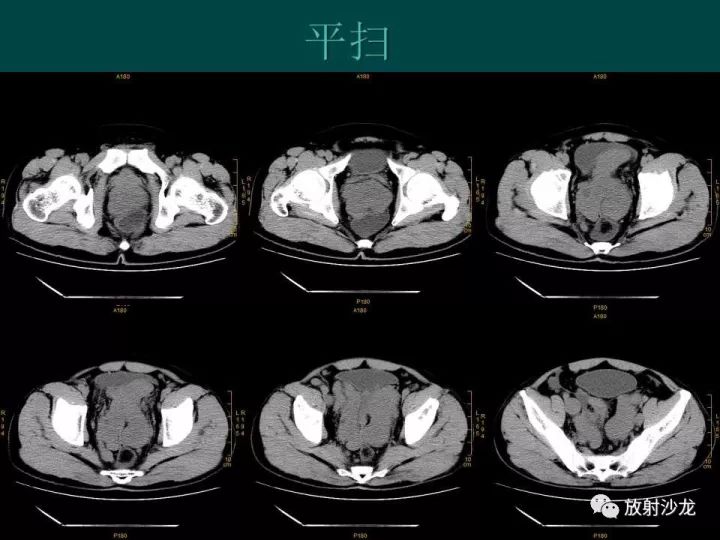 【病例】促结缔组织增生性小圆细胞肿瘤1例CT影像表现