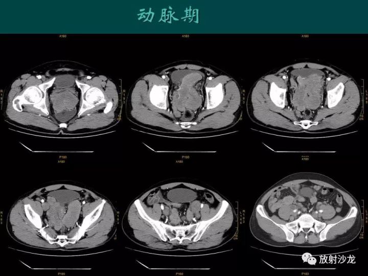 【病例】促结缔组织增生性小圆细胞肿瘤1例CT影像表现