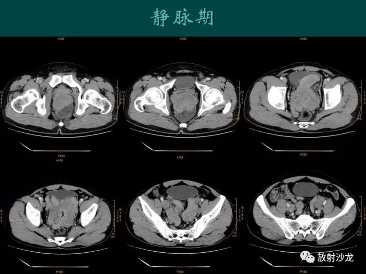 【病例】促结缔组织增生性小圆细胞肿瘤1例CT影像表现