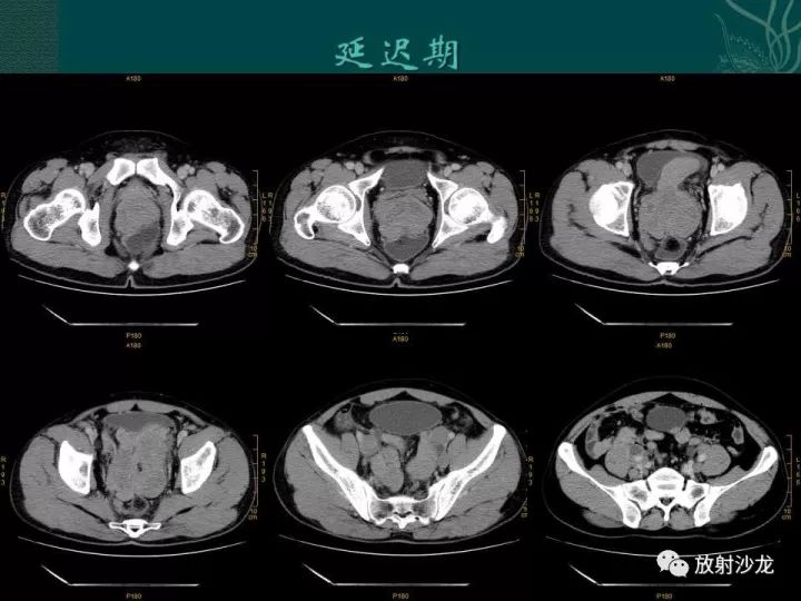 【病例】促结缔组织增生性小圆细胞肿瘤1例CT影像表现