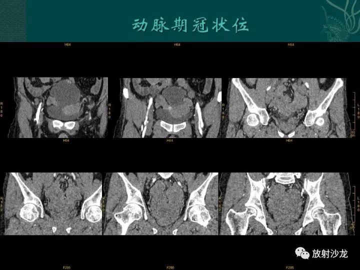 【病例】促结缔组织增生性小圆细胞肿瘤1例CT影像表现