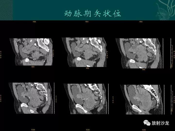 【病例】促结缔组织增生性小圆细胞肿瘤1例CT影像表现