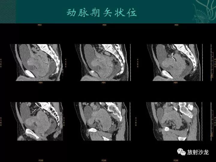 【病例】促结缔组织增生性小圆细胞肿瘤1例CT影像表现