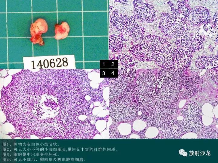 【病例】促结缔组织增生性小圆细胞肿瘤1例CT影像表现