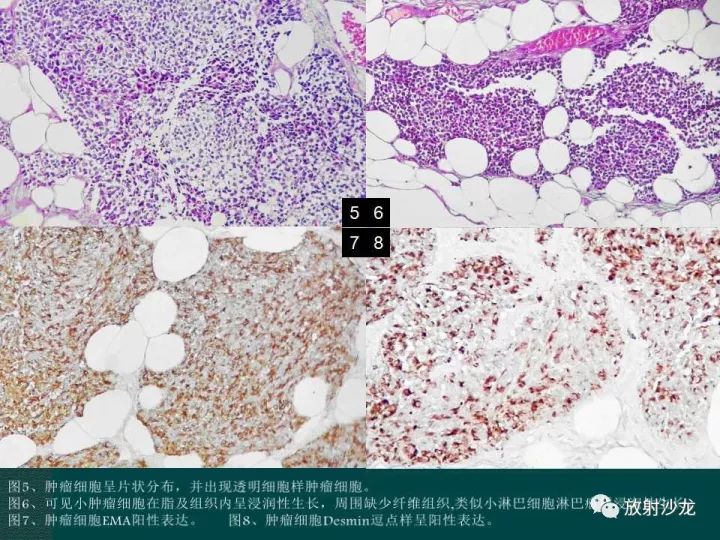 【病例】促结缔组织增生性小圆细胞肿瘤1例CT影像表现