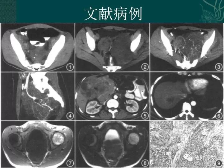 【病例】促结缔组织增生性小圆细胞肿瘤1例CT影像表现
