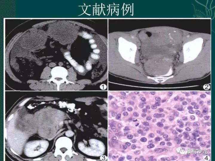 【病例】促结缔组织增生性小圆细胞肿瘤1例CT影像表现