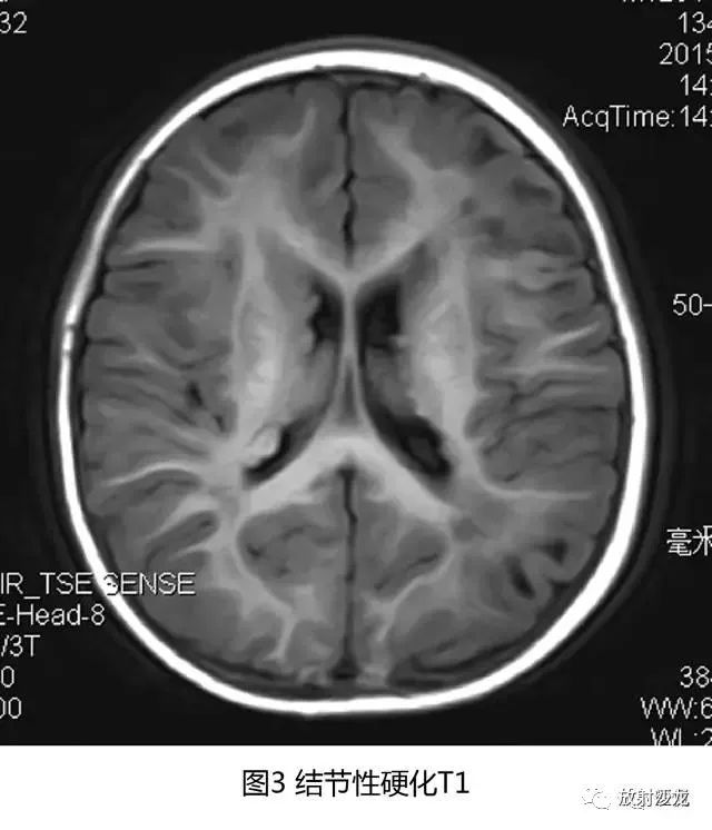 【病例】结节性硬化1例CT及MR影像表现 【病例】结节性硬化1例CT及MR影像表现