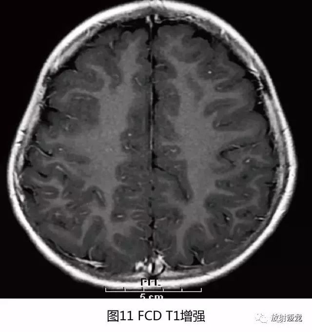 【病例】结节性硬化1例CT及MR影像表现 【病例】结节性硬化1例CT及MR影像表现
