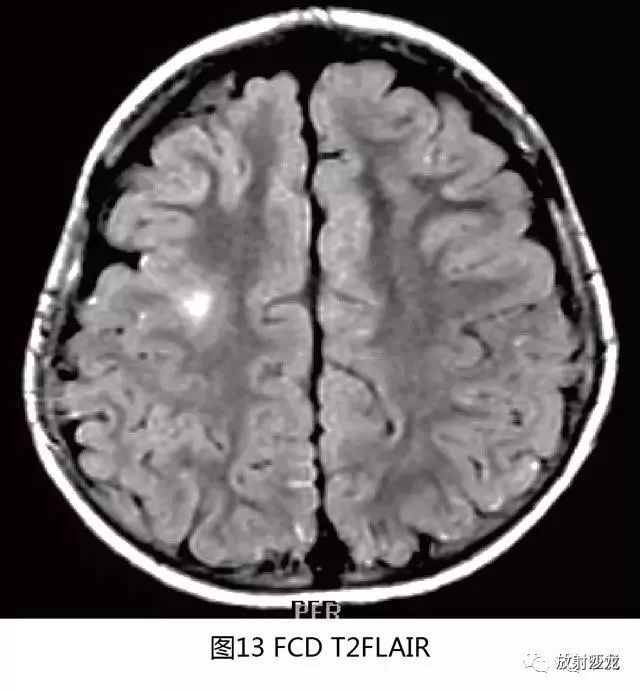 【病例】结节性硬化1例CT及MR影像表现 【病例】结节性硬化1例CT及MR影像表现