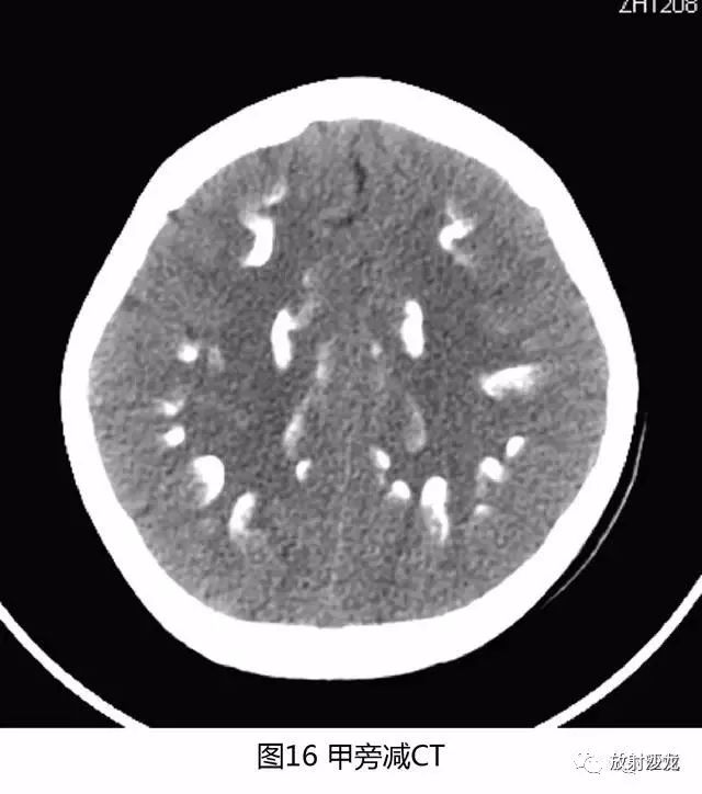【病例】结节性硬化1例CT及MR影像表现 【病例】结节性硬化1例CT及MR影像表现
