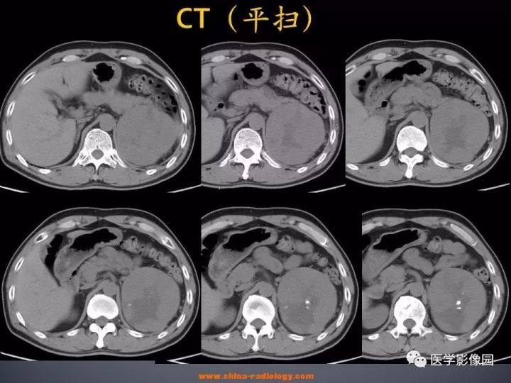 【病例】肾上腺嗜酸细胞腺瘤1例CT影像表现