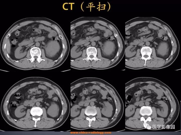【病例】肾上腺嗜酸细胞腺瘤1例CT影像表现