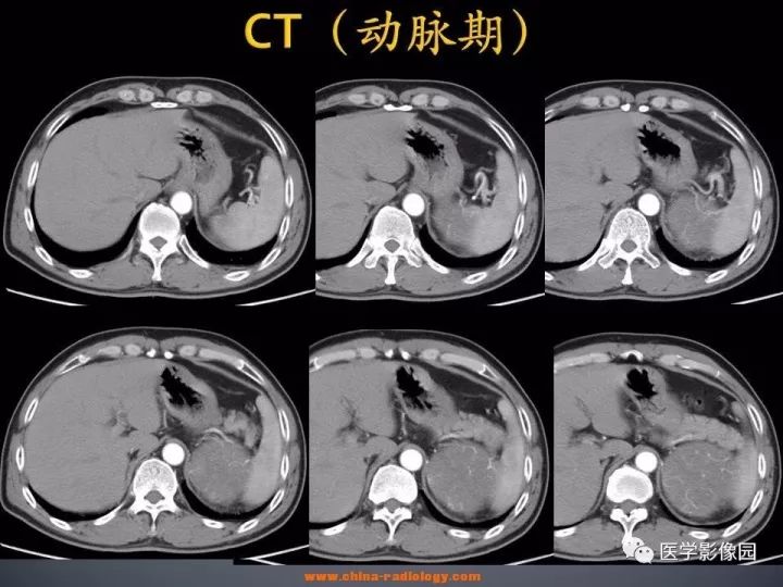 【病例】肾上腺嗜酸细胞腺瘤1例CT影像表现