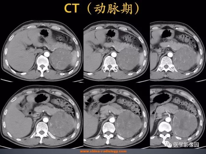 【病例】肾上腺嗜酸细胞腺瘤1例CT影像表现