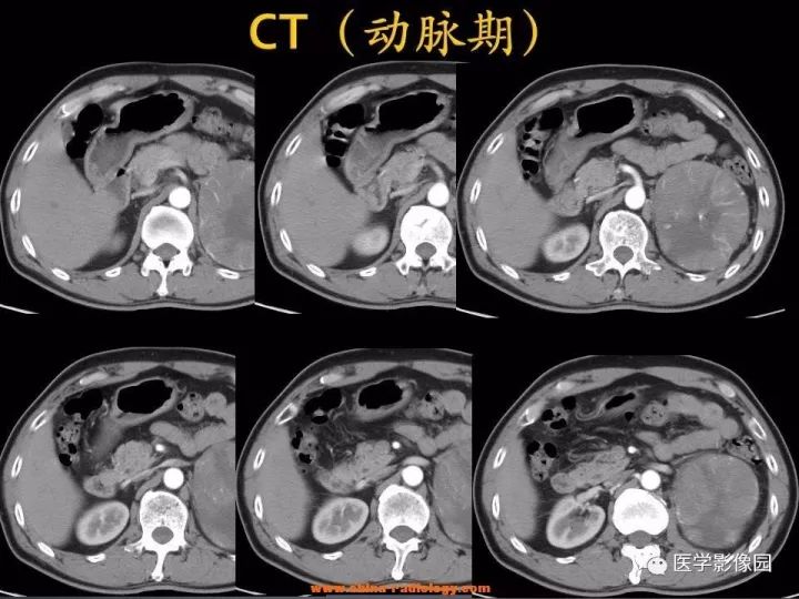 【病例】肾上腺嗜酸细胞腺瘤1例CT影像表现