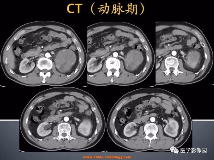 【病例】肾上腺嗜酸细胞腺瘤1例CT影像表现