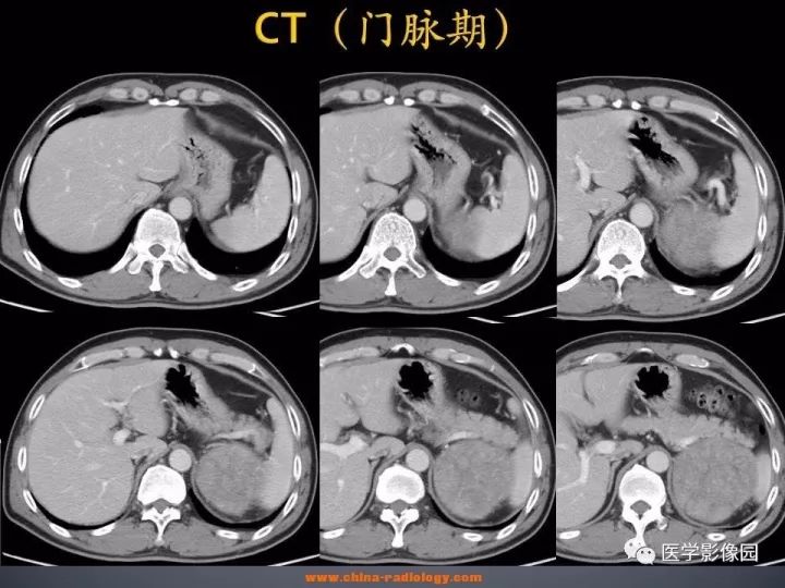 【病例】肾上腺嗜酸细胞腺瘤1例CT影像表现