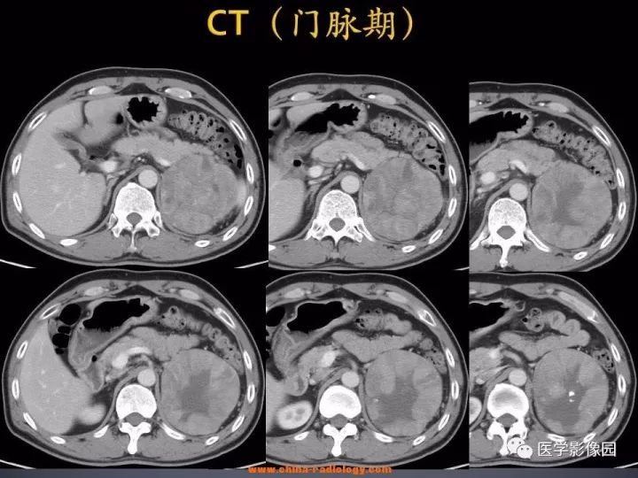 【病例】肾上腺嗜酸细胞腺瘤1例CT影像表现
