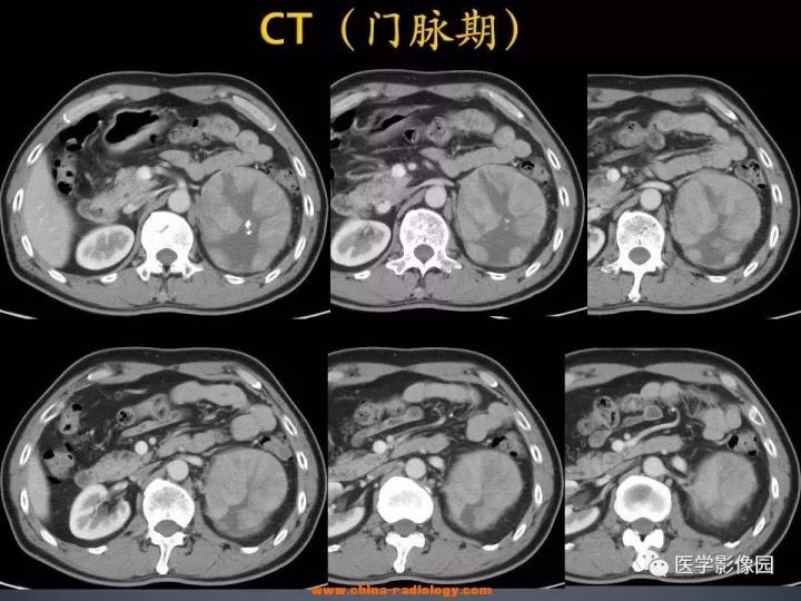 【病例】肾上腺嗜酸细胞腺瘤1例CT影像表现