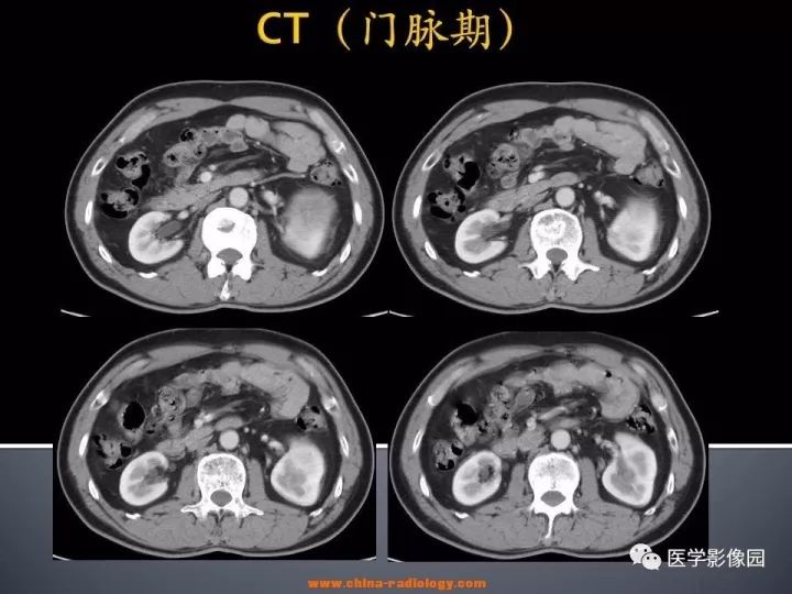 【病例】肾上腺嗜酸细胞腺瘤1例CT影像表现